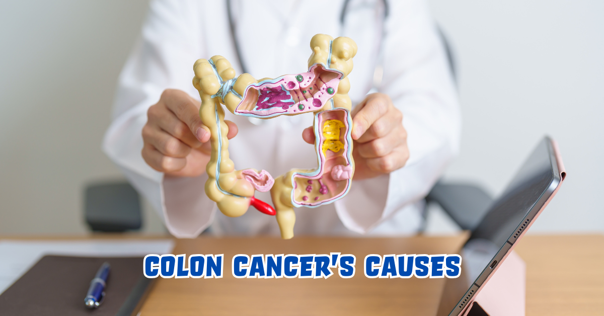 Colon Cancer