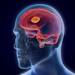 Functional Neurological Disorder