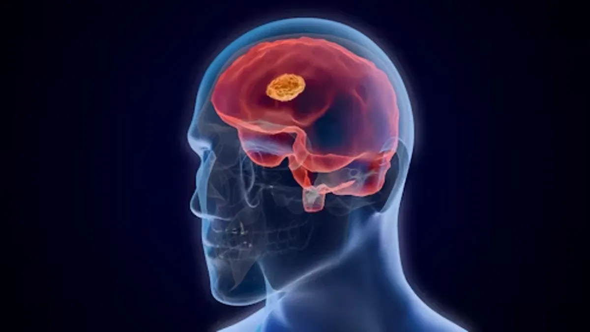 Functional Neurological Disorder